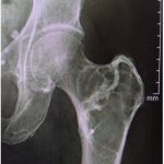 Bridging Osteophytes/DISH (NC)