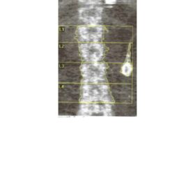 Bariatric Surgery Lap Band Artifact