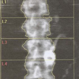 Bariatric Surgery Lap Band Artifact