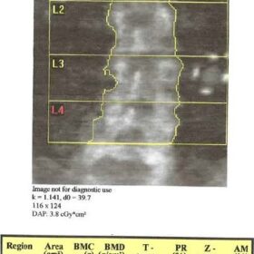 Bariatric Surgery Artifacts- LapBand Port