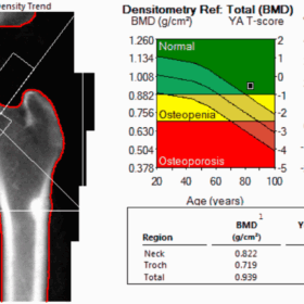AFF identified on hip DXA