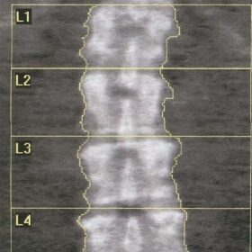 4 Lumbar Vertebral Bodies