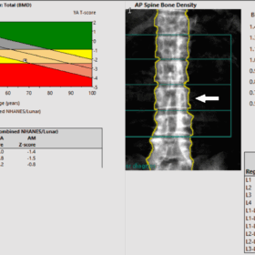 Aortic calcification on spine DXA