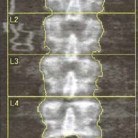 Biliary Drainage Catheter