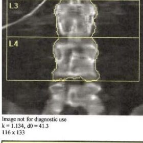 Catheter
