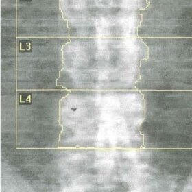 Endograft