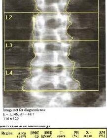 Inferior Vena Caval (IVC) Filter