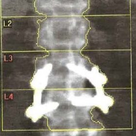 Spinal Hardware