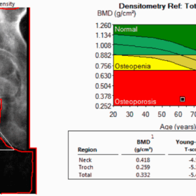 Osteoporosis and Unexpected Osteosclerosis