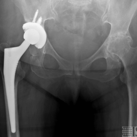 Hip Osteoarthritis - How Bad Can It Get?