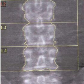 Metastatic Breast Cancer