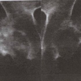 Bilateral Hip Fractures