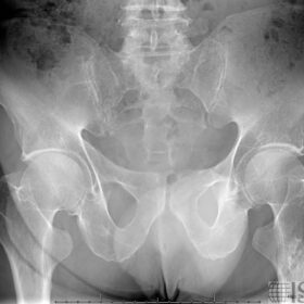 Benign Bone Lesions - Bone Infarct