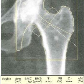 Benign Bone Lesion - Bone Island