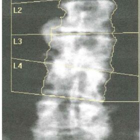Bridging Osteophytes