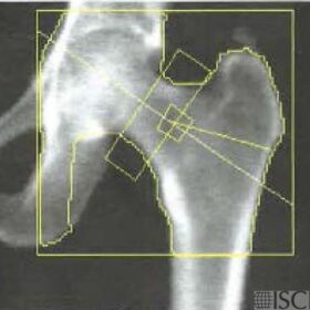 Calcified Tendon