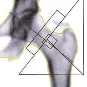 Calcific Tendonitis/Bursitis