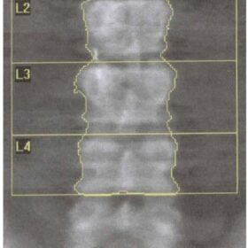 Pancreatic Calcification