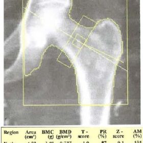 Calcinosis