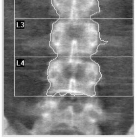 Cystic Fibrosis