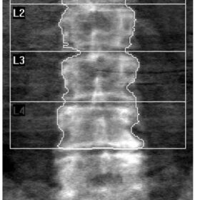 Ehlers-Danlos Syndrome