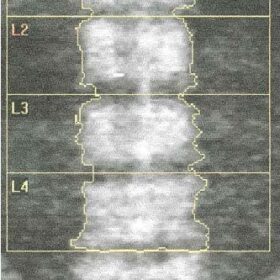 Elevated Bone Mineral Density