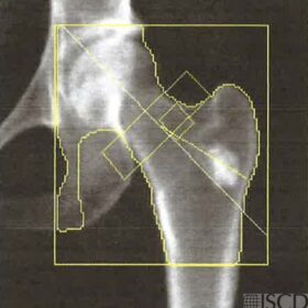 Benign Bone Lesion - Enchondroma