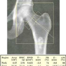 Benign Bone Lesion - Enchondroma