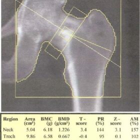 Femoral Neck Fracture