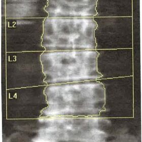 Cholelithiasis/ Gallstones