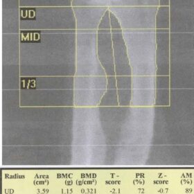 Hypophosphatemic Rickets