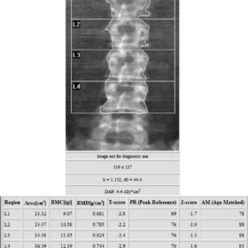 Hyperthyroidism