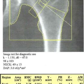 Primary Hyperparathyroidism