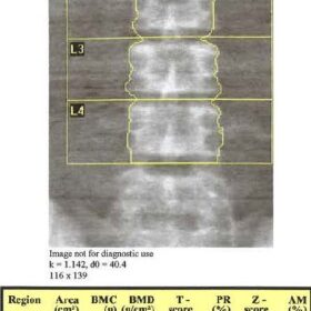 Ascites and Indwelling Peritoneal Dialysate