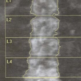 Nephrolithiasis