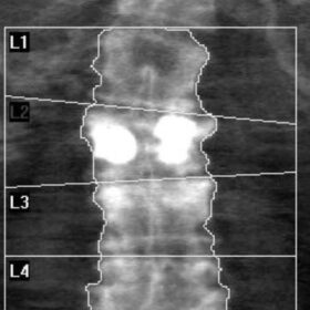 Vertebral Augmentation