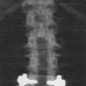 Laminectomy
