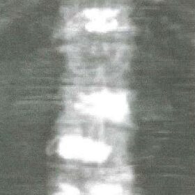 Vertebral Augmentation