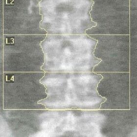 Nephrectomy Clips