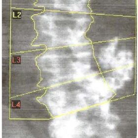Neuroblastoma/Retroperitoneal Ganglioneuroma