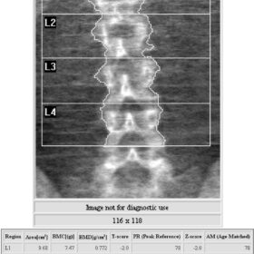 Osteogensis Imperfecta
