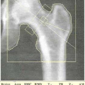 Paget's Disease