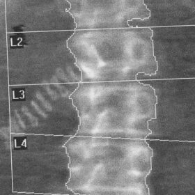Surgical Clips