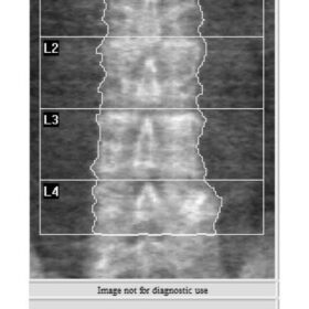 Oncogenic Osteomalacia/Tumor-Induced Osteomalacia