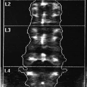 Incorrect Spine Analysis