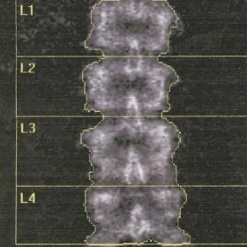 Spinal Level Identification