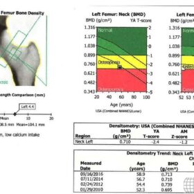 Incorrect  GE Hip Analysis