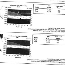 Incorrect Hip Analysis