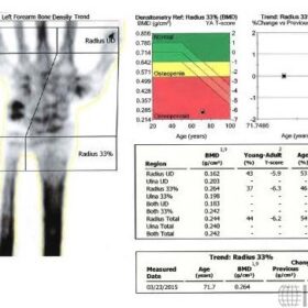 Incorrect Wrist Scan Analysis