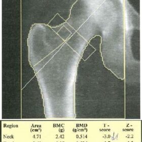 Total Hip Region of Interest Incorrect/Hologic